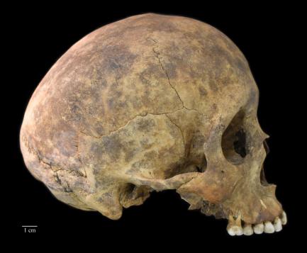 One of two cases of healed blows to the cranium from the Playa Venado excavation